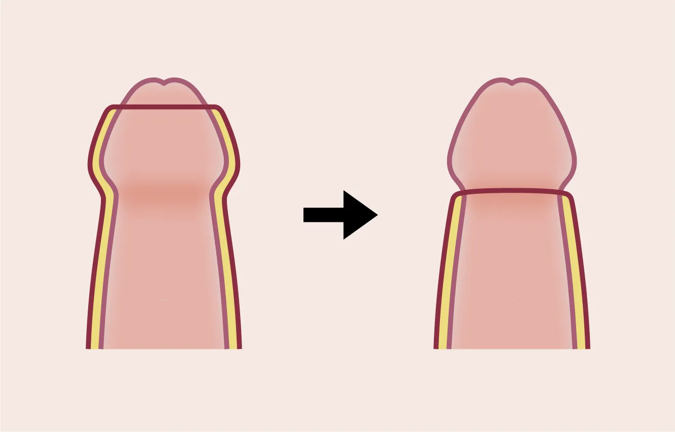 包茎手術のイメージ