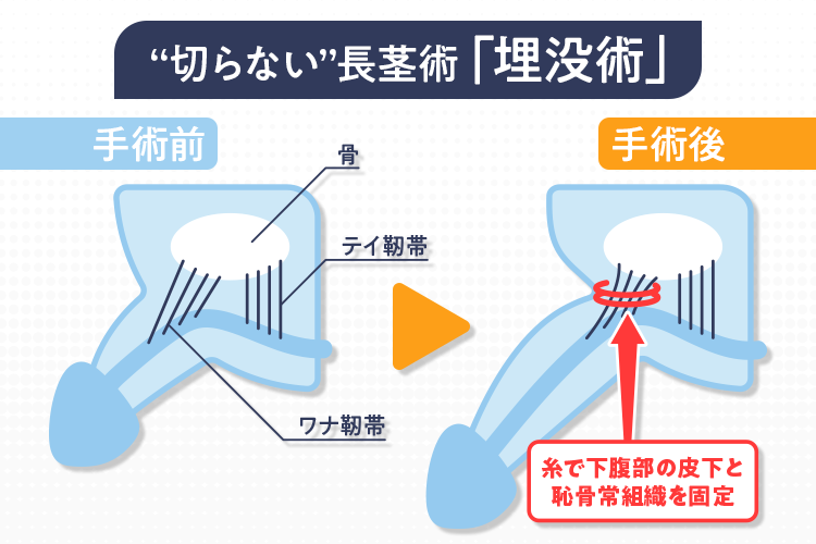 切らない長茎術（埋没法）のイメージ図