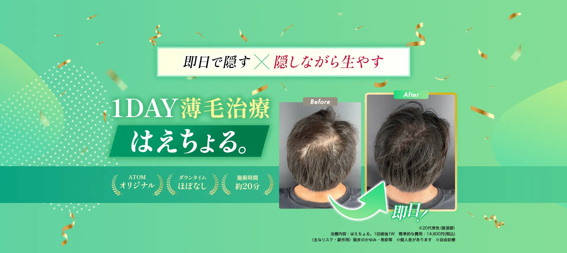即日で隠すx隠しながら生やす1day薄毛治療はえちょる。