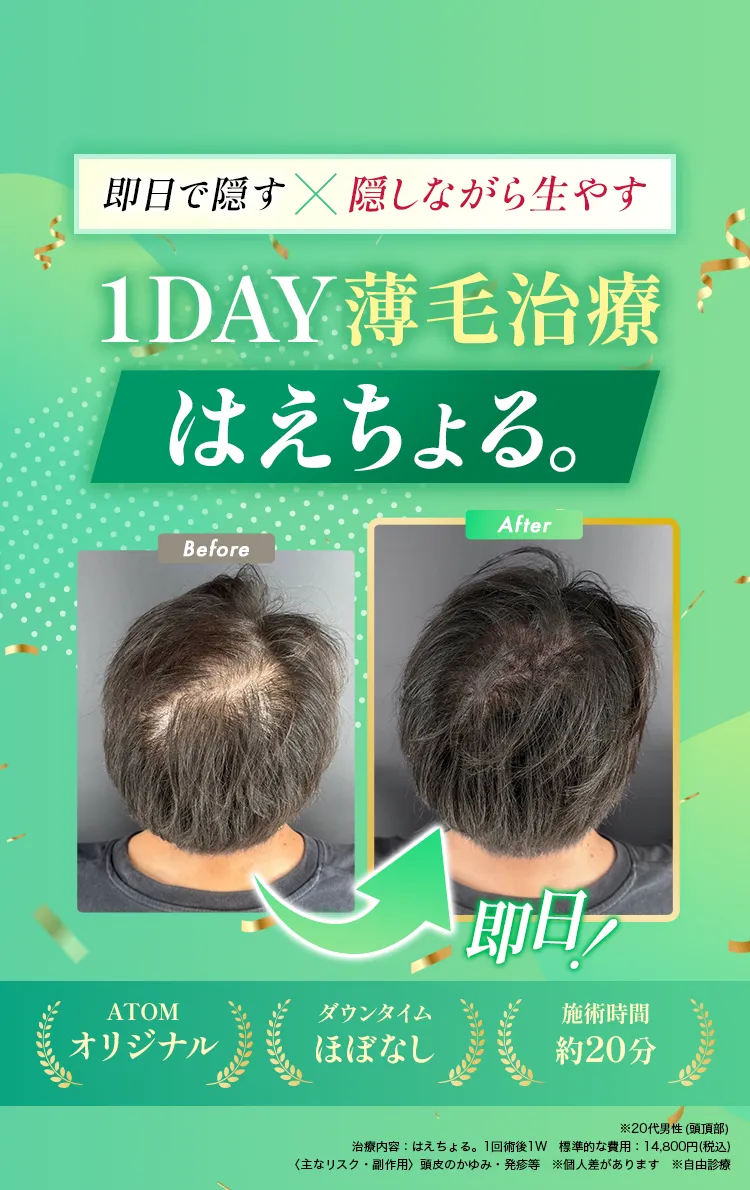 即日で隠すx隠しながら生やす1day薄毛治療はえちょる。