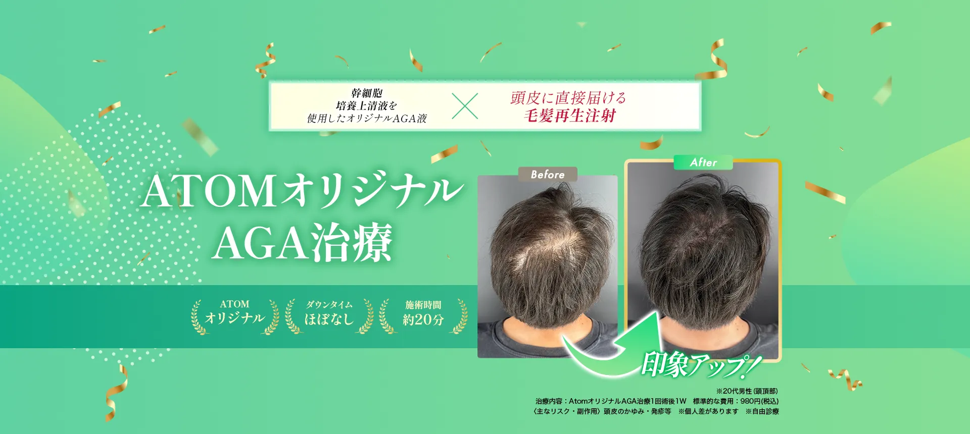 即日で隠すx隠しながら生やす1day薄毛治療オリジナルAGA治療