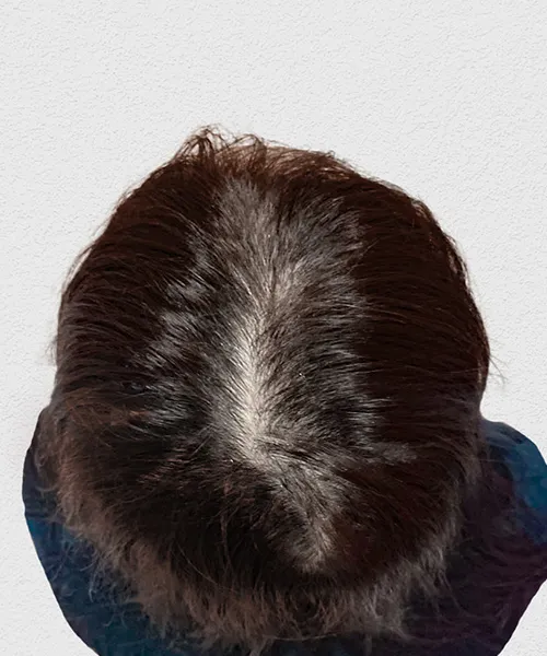 はえちょるの施術後6か月目に撮影したつむじ付近の写真