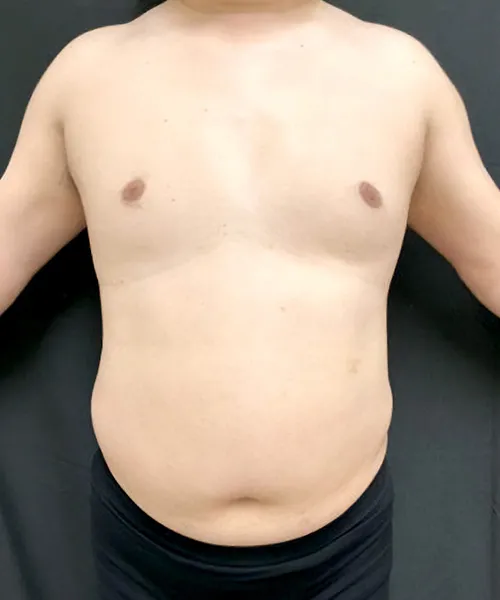 医療ダイエット（メディカルダイエット）でマンジャロ(ゼップバウンド)＋脂肪破壊スルリム注射α＋ダパグリフロジン＋メトホルミンの施術をした男性の施術後写真