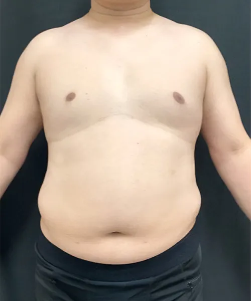 医療ダイエット（メディカルダイエット）でマンジャロ(ゼップバウンド)＋脂肪破壊スルリム注射α＋ダパグリフロジン＋メトホルミンの施術をする男性の施術前写真