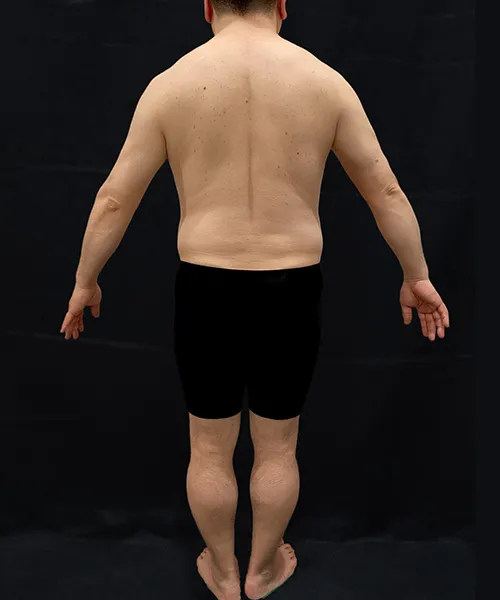 医療ダイエット（メディカルダイエット）で肪破壊スルリム注射＋マンジャロ(ゼップバウンド)＋メトホルミンの施術をした男性の施術後写真