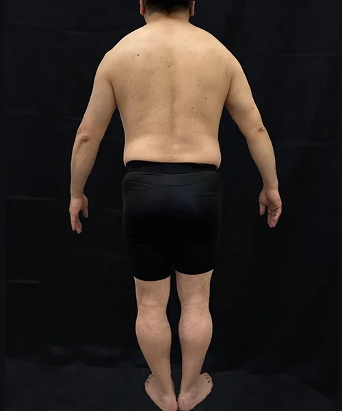 医療ダイエット（メディカルダイエット）で肪破壊スルリム注射＋マンジャロ(ゼップバウンド)＋メトホルミンの施術をする男性の施術前写真