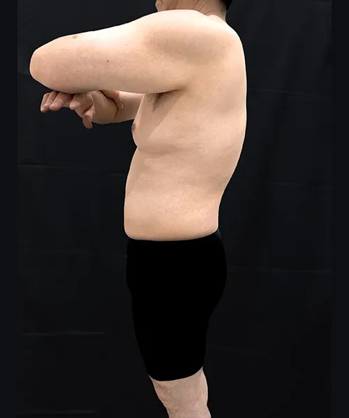 医療ダイエット（メディカルダイエット）で脂肪破壊スルリム注射α＋オゼンピック＋カナグルの施術をした男性の施術後写真