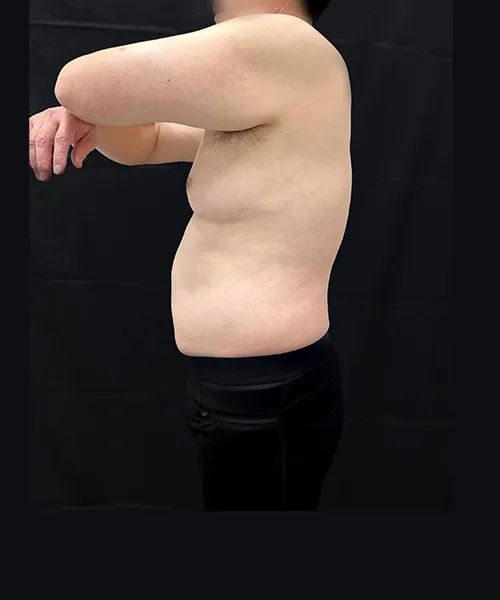 医療ダイエット（メディカルダイエット）で脂肪破壊スルリム注射α＋オゼンピック＋カナグルの施術する男性の施術前写真