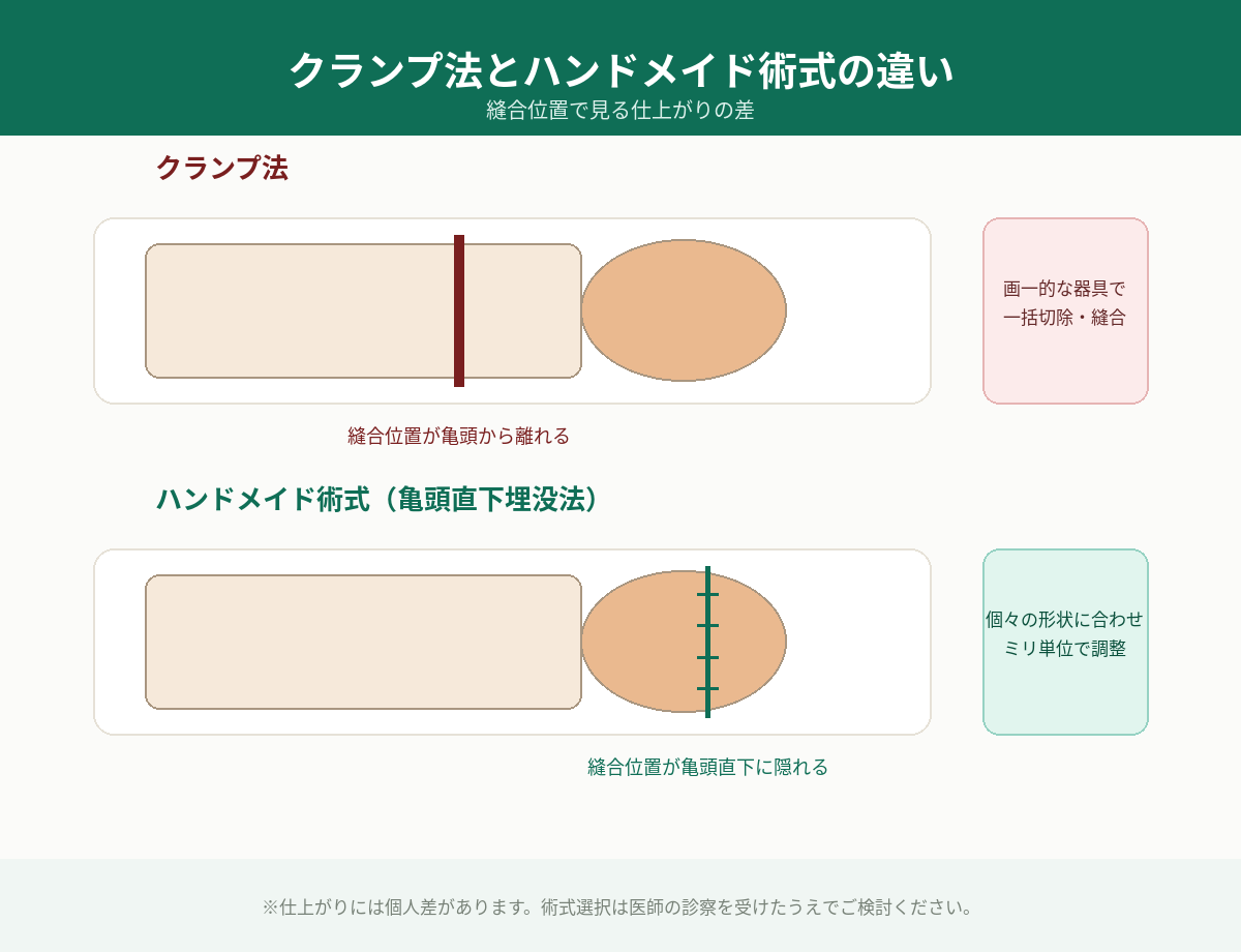 縫合位置比較図（クランプ法 vs 亀頭直下埋没法）