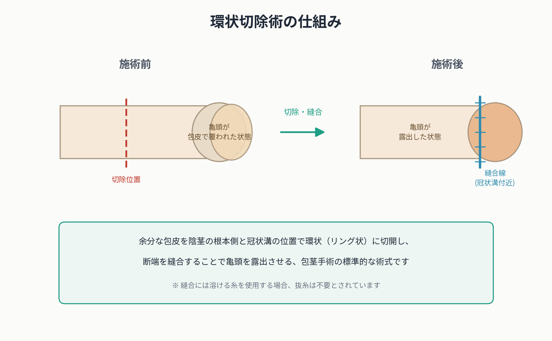 環状切除術の施術前・施術後を比較した仕組み図解