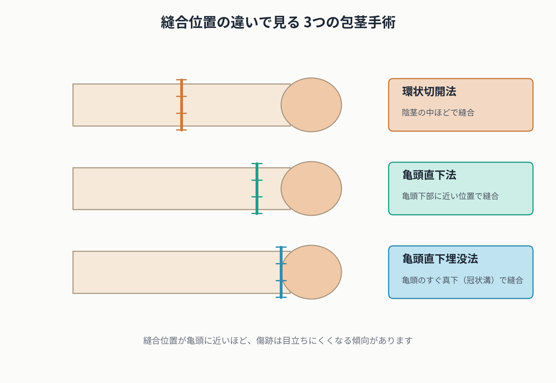 環状切開法・亀頭直下法・亀頭直下埋没法の縫合位置比較図